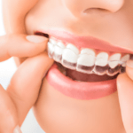 Invisalign and Rubber Bands: When Are They Necessary?